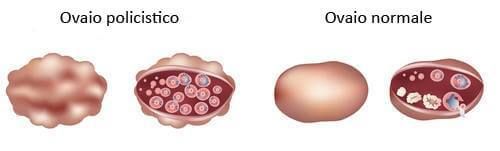 Differenze Ovaio Policistico e Ovaio normale